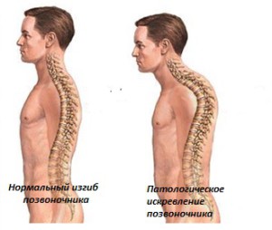 кифоз позвоночника